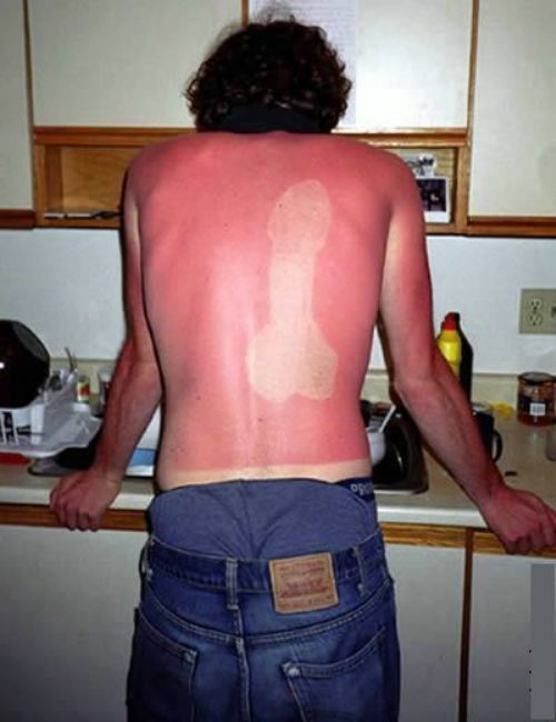 Sunburn-prank.jpg